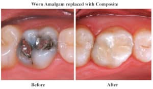 Tooth-colored fillings in Chicago, Evanston, & Skokie
