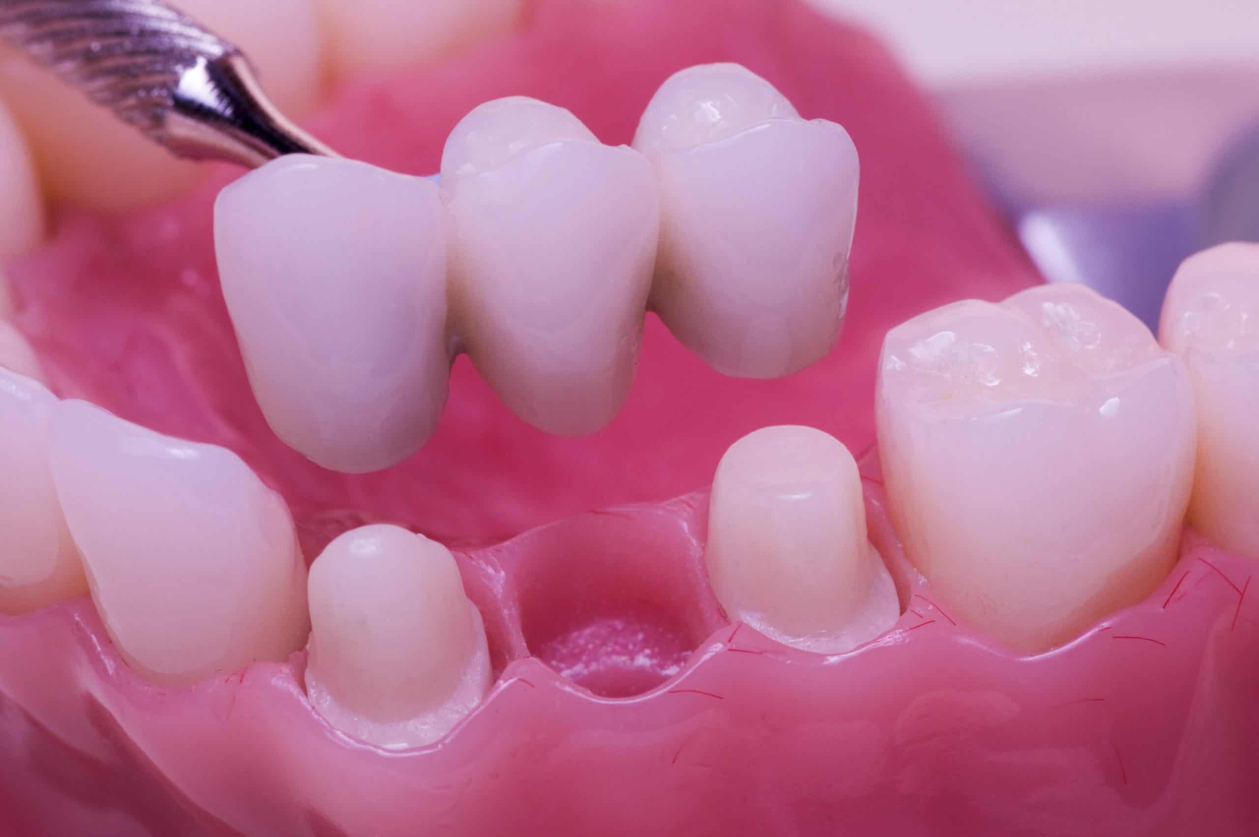 Dental Bridges in Chicago, Evanston, & Skokie