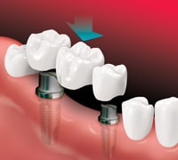 A bridge is placed on implants