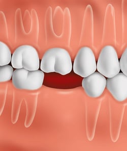 Position of teeth immediately, after a tooth is lost