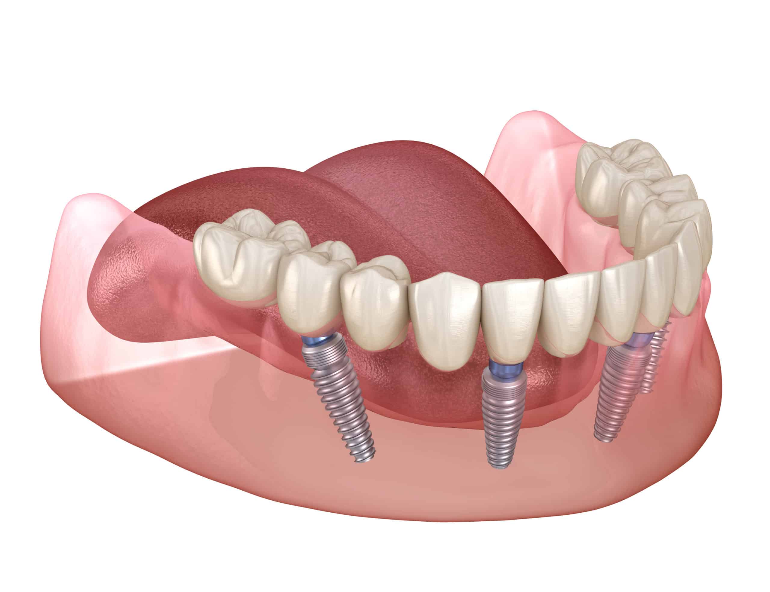 All-on-Four dental implants in Chicago, Evanston, Skokie