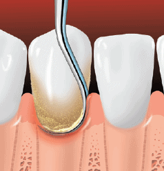 Scaling removes plaque and tartar from below the gumline.