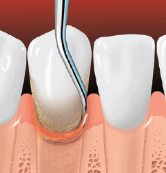 Root planing smoothes the tooth root and helps the gums reattach to the tooth.