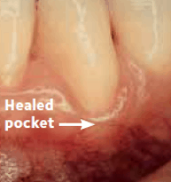 Healed pocket after treatment.