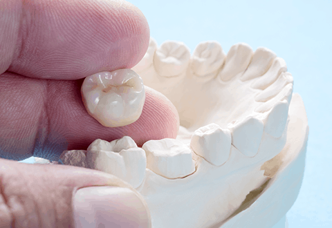 Dental Crowns in Chicago, Evanston, Skokie