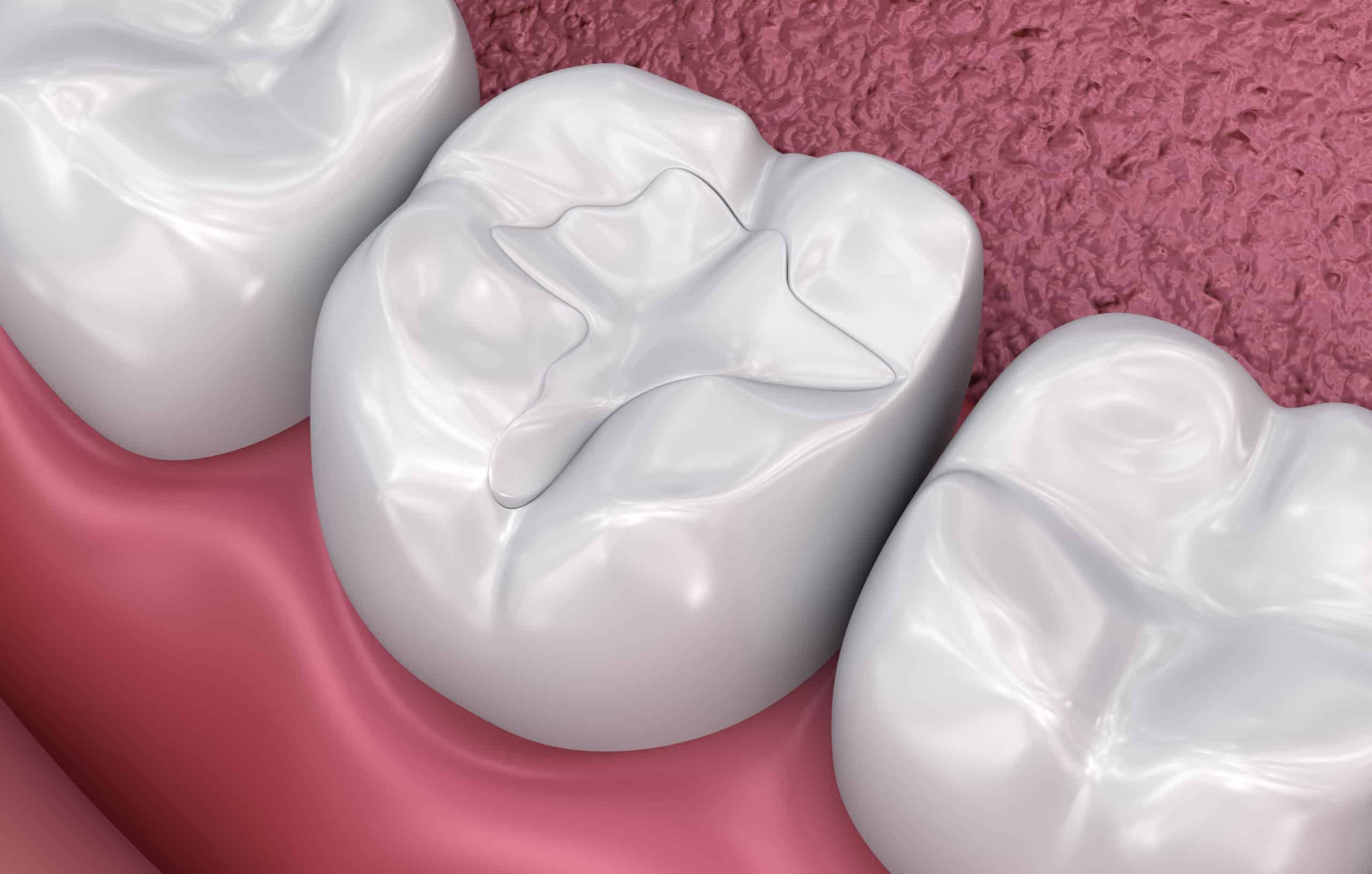 Fillings in Chicago, Evanston, & Skokie