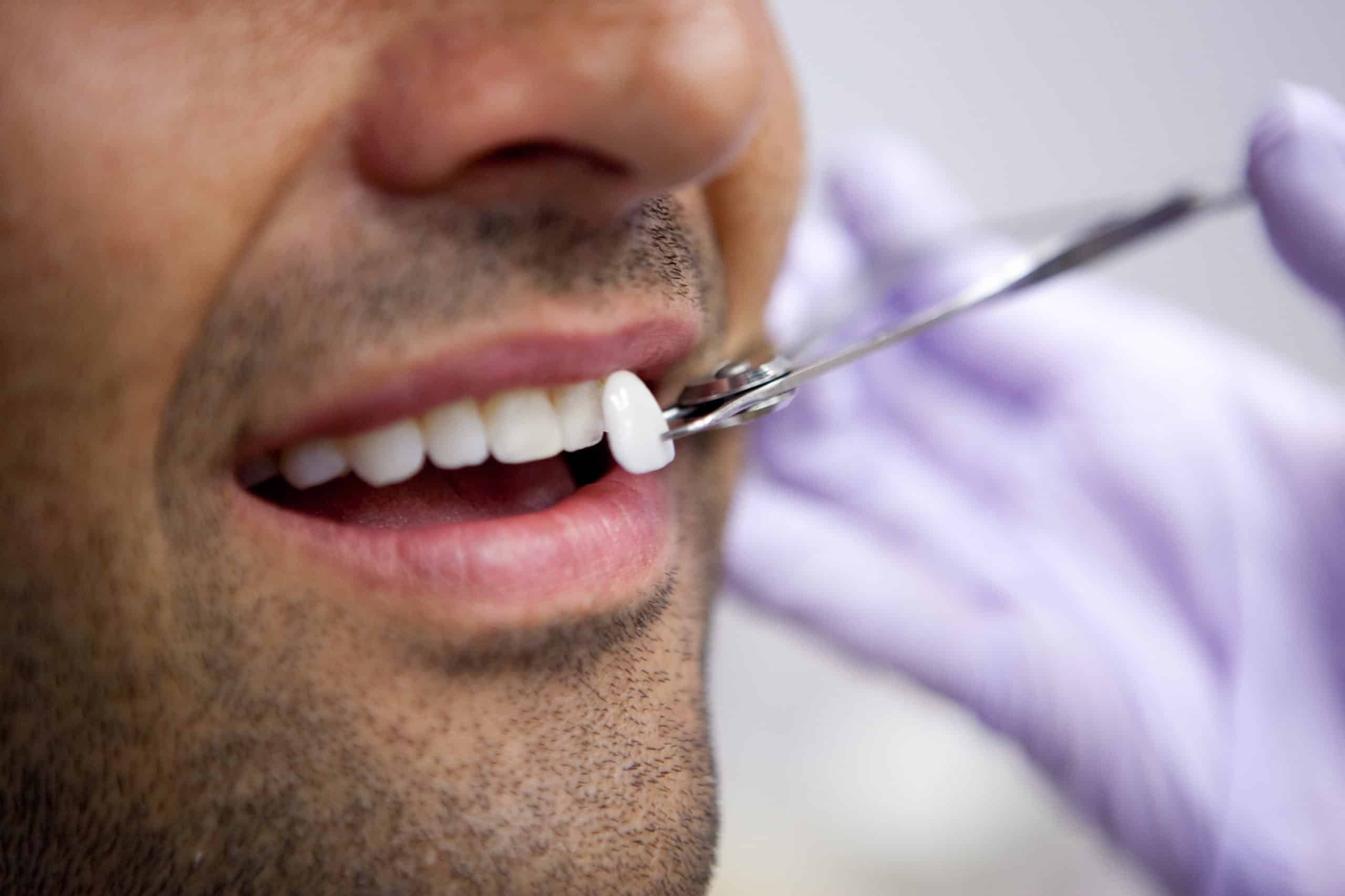Dental veneers in Chicago, Evanston, & Skokie