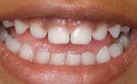 Healthy baby (primary) teeth