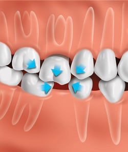 If the tooth is not replaced, other teeth can drift out of position and change the bite