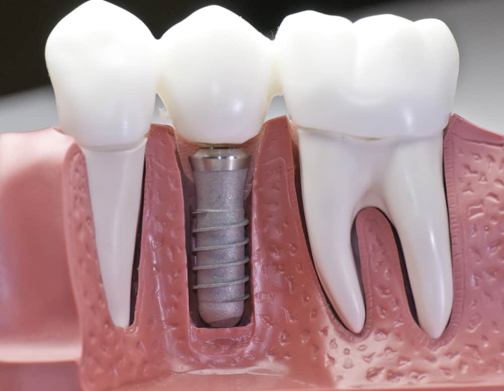 Dental implants in Chicago, Evanston, & Skokie