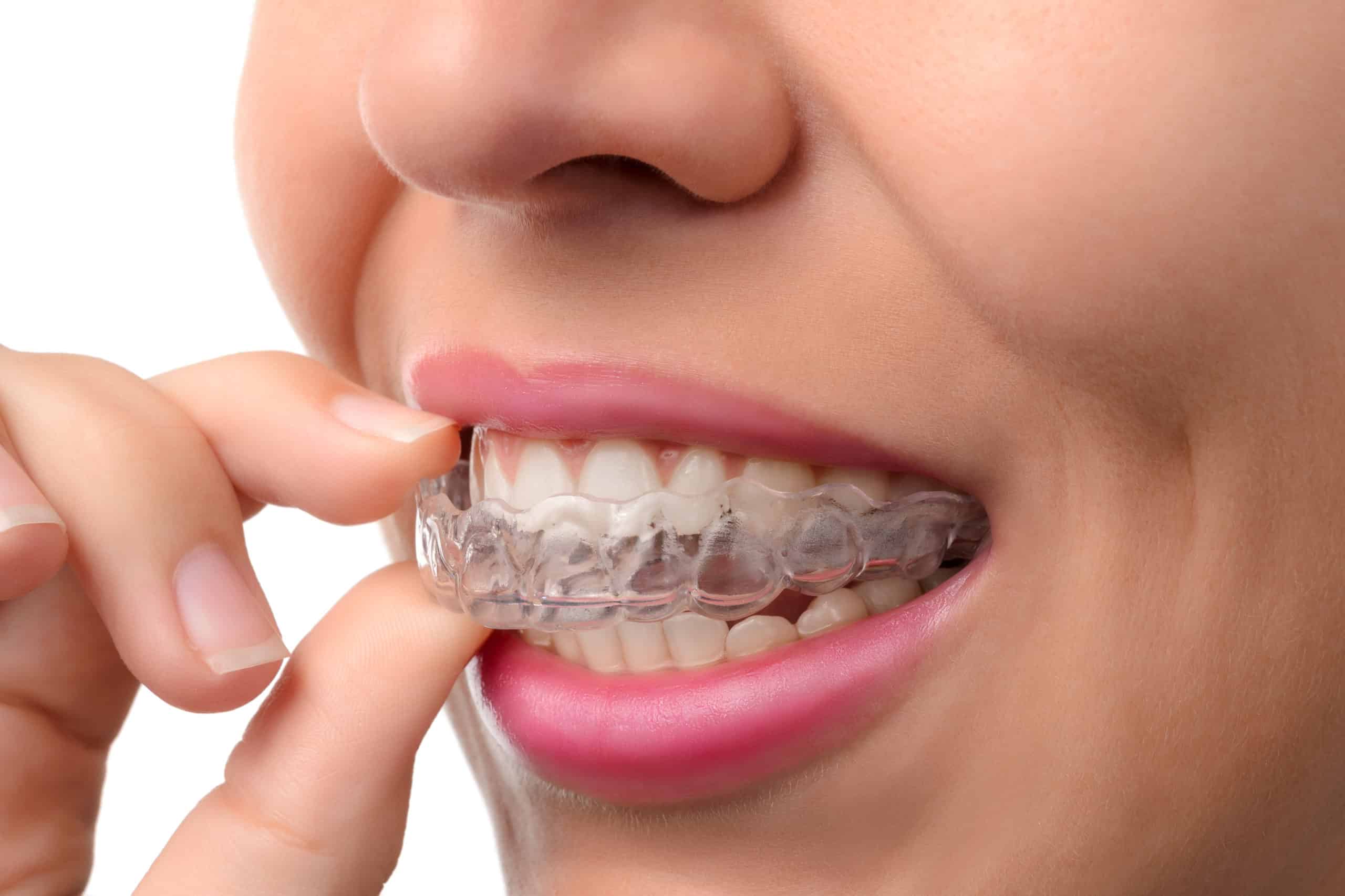 Invisalign® in Chicago, Evanston, & Skokie