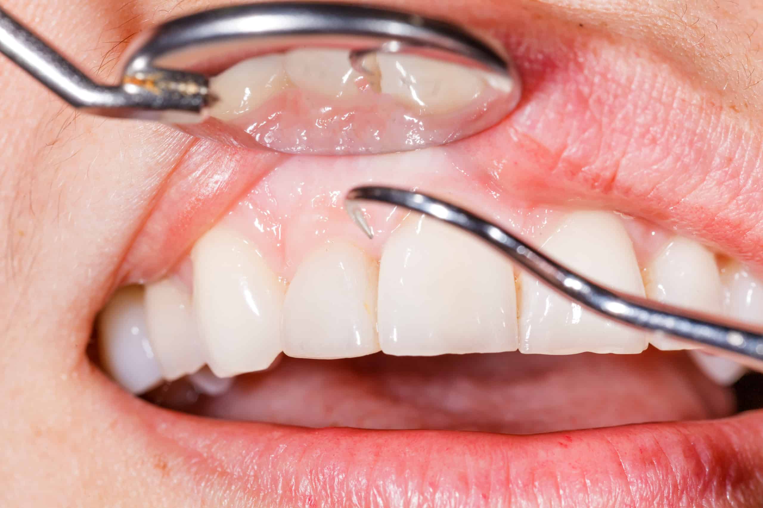 Periodontal disease treatments in Chicago, Evanston, & Skokie