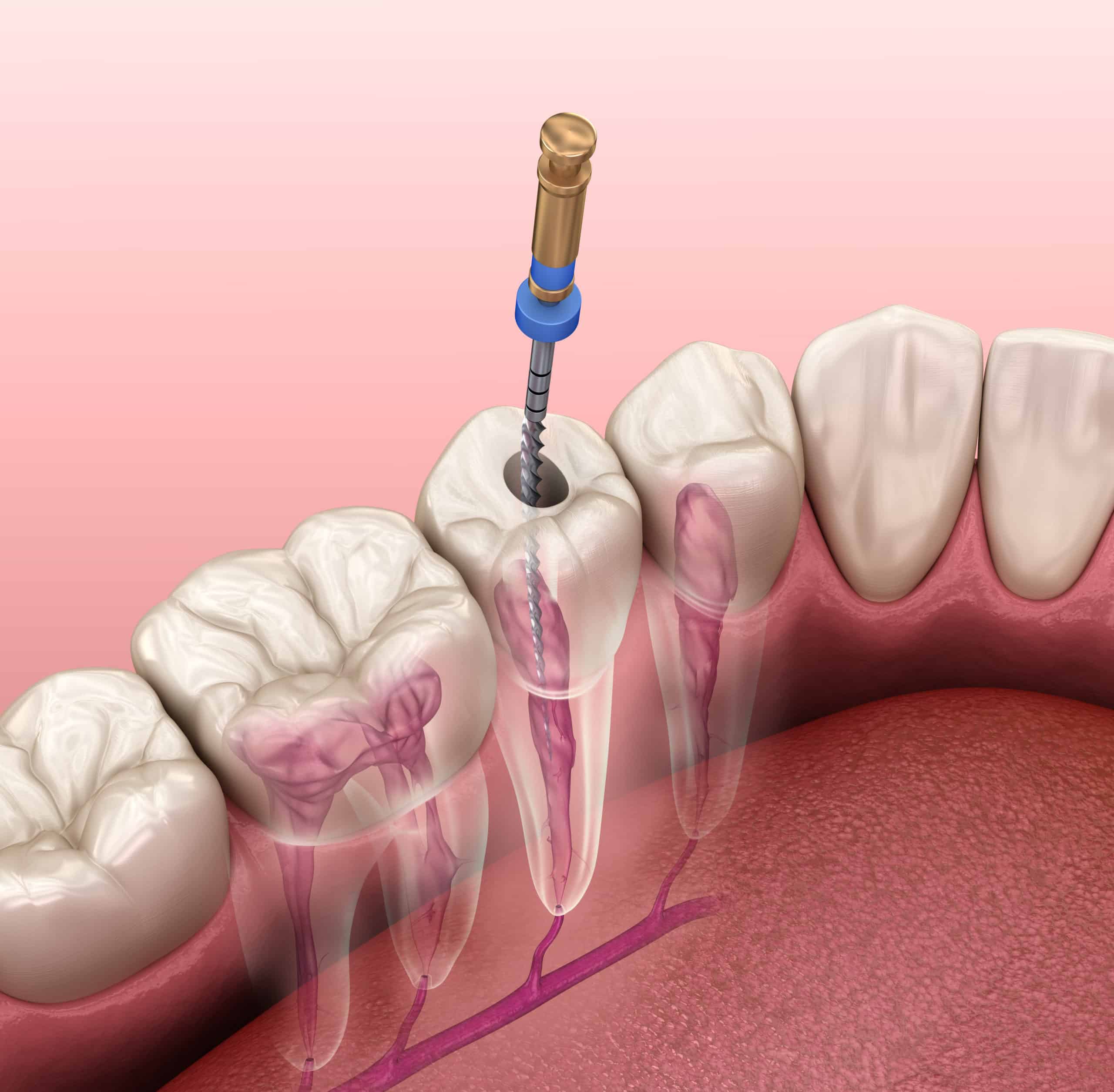 Root canals in Chicago, Evanston, & Skokie