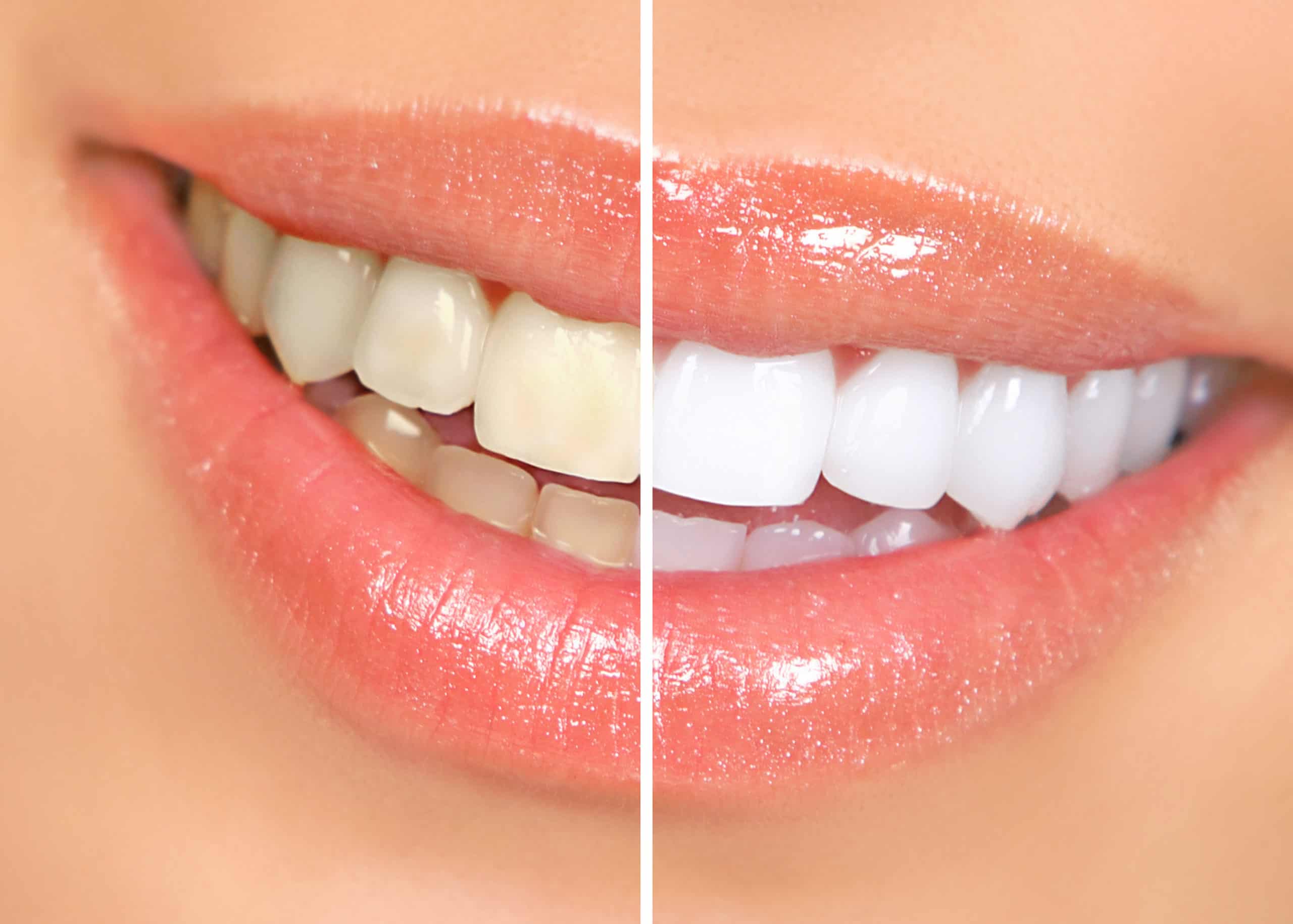 Teeth Whitening in Chicago, Evanston, & Skokie